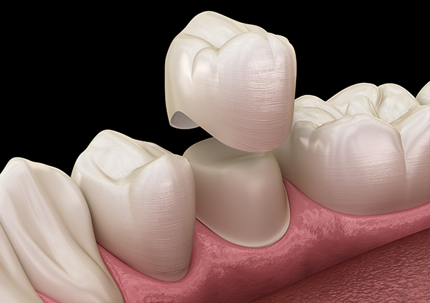 被せもの・クラウン