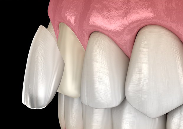 ラミネートベニア
