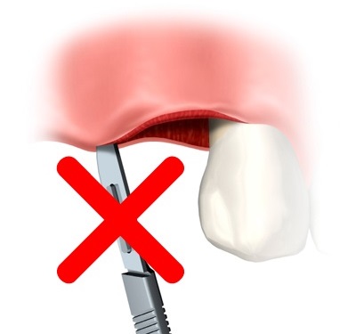 フラップレス術式