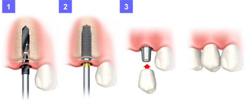 メスを使用しない無切開フラップレス手術