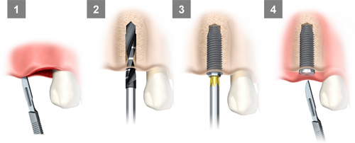 一般的な2回法インプラント手術