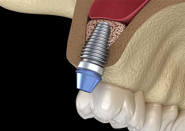 バーティカル・サイナスリフト