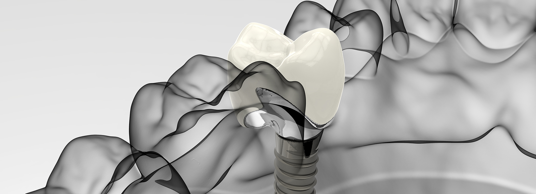 インプラント治療