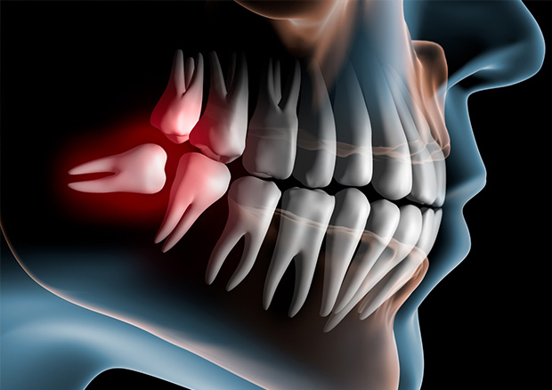 痛くない親知らずの抜歯