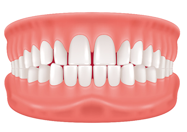 すきっ歯（空隙歯列弓）